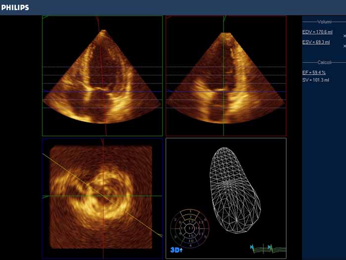 ECOGRAFIE CARDIACHE TRANS-ESOFAGEE E BRONCOSCOPIE